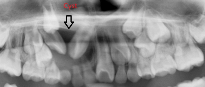 Cyst Removal